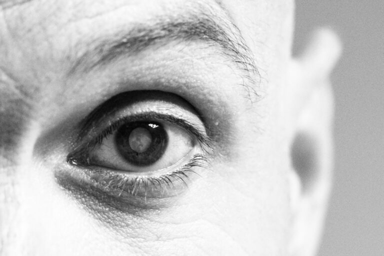 What are Cataracts? And the Symptoms - Cathedral Eye Clinic