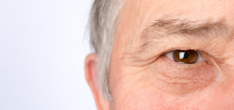 Ptosis (Drooping Eyelid Surgery)
